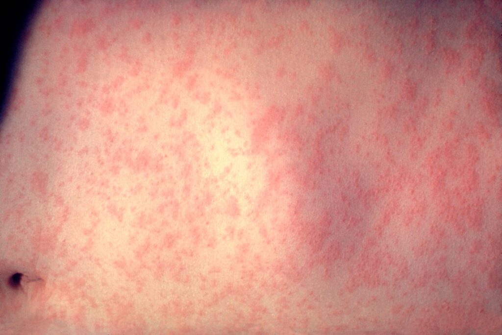 Morbillivirus_measles_infection