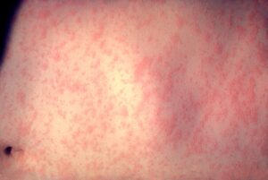 Morbillivirus_measles_infection